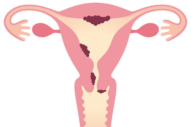 子宮がんの特徴