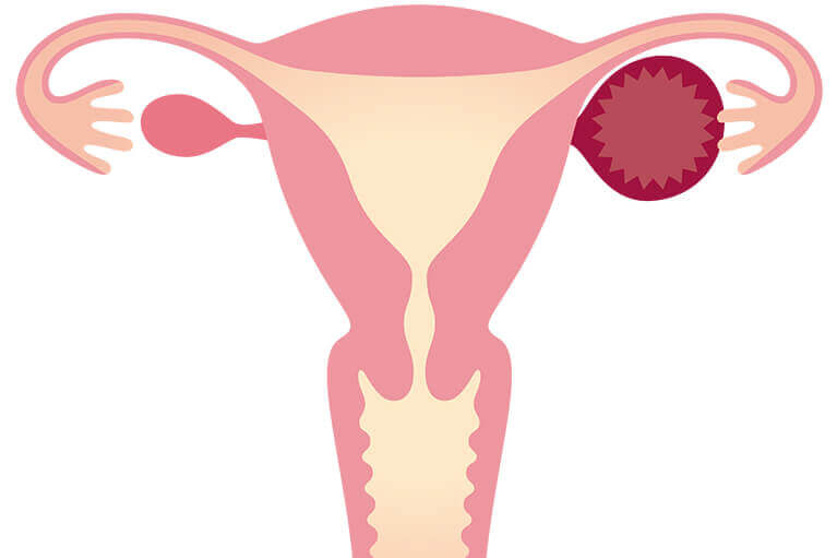 卵巣にできる腫瘍の9割以上が良性の腫瘍です。